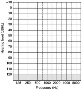schwabach test|The audiogram: Detection of pure.